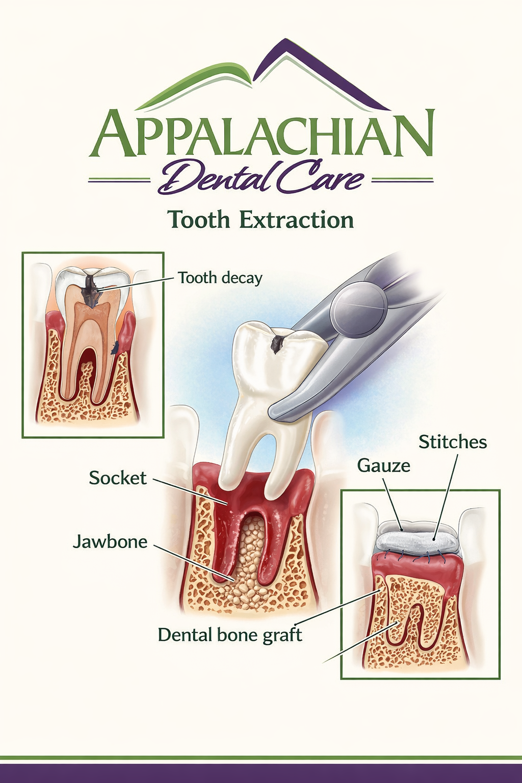 ADC Tooth Extraction 