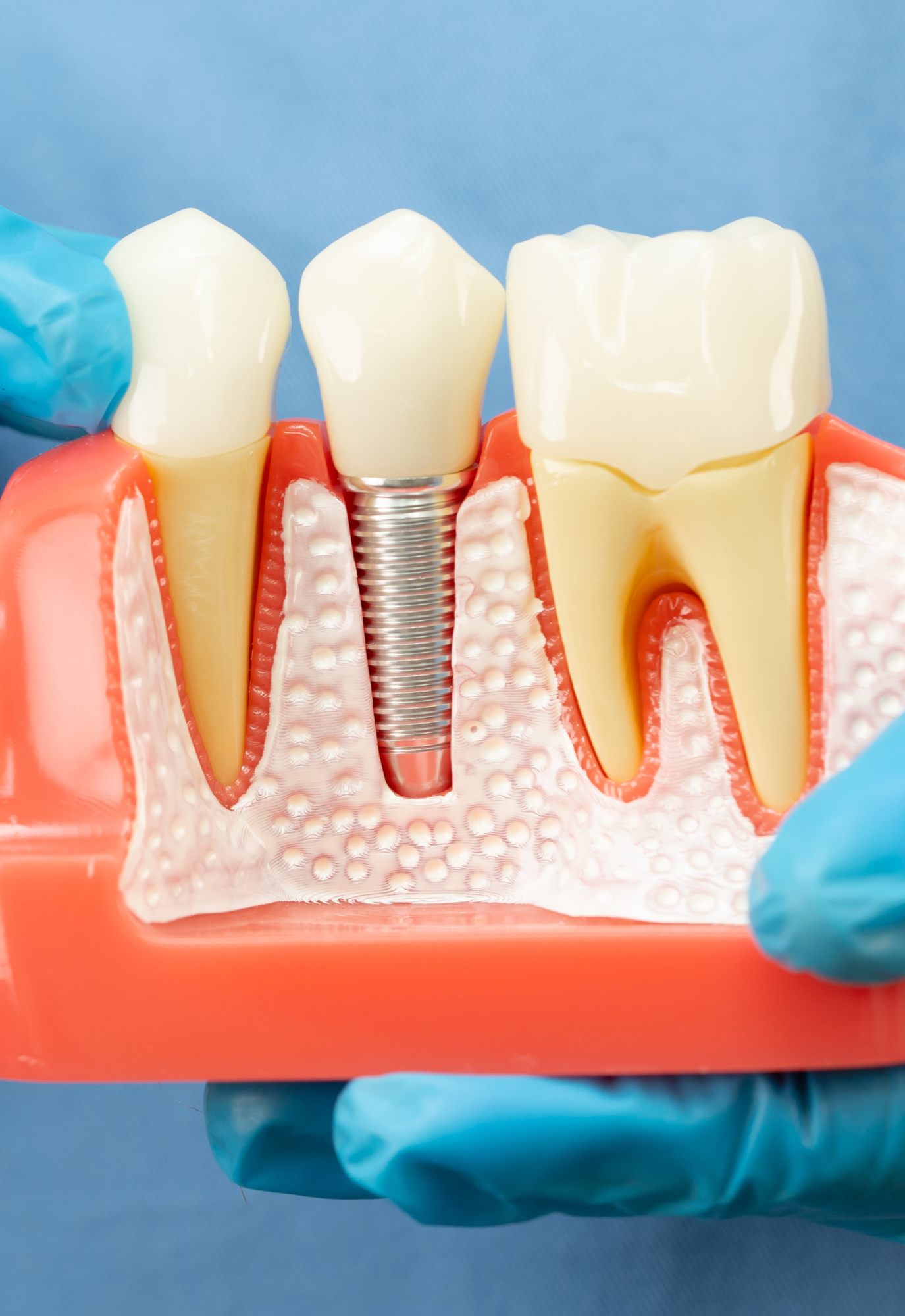 single tooth implant