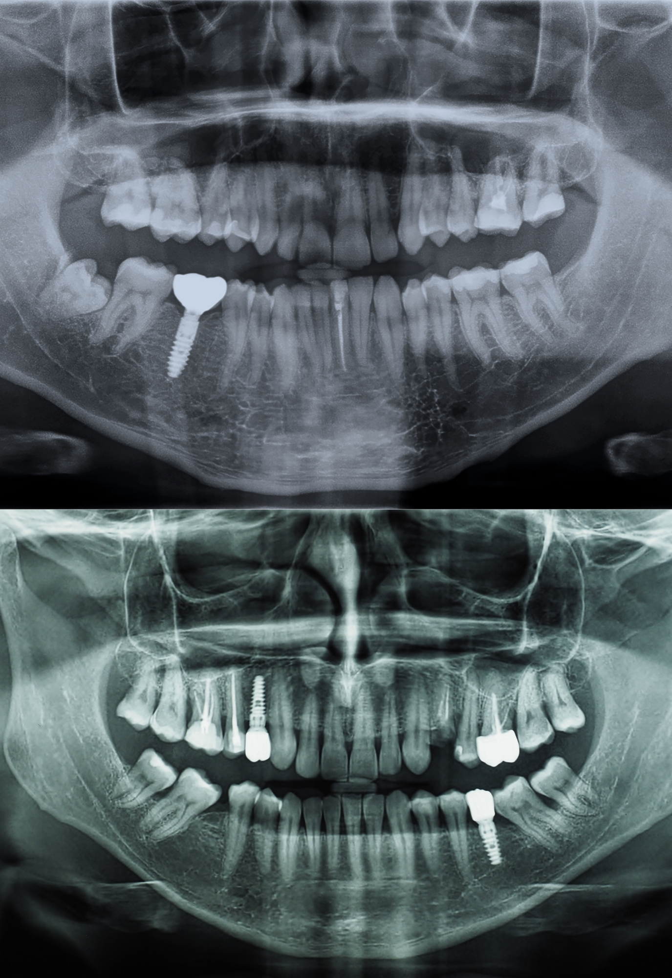 dental implant x-ray